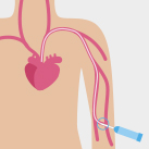 PICC-Line-Katheter